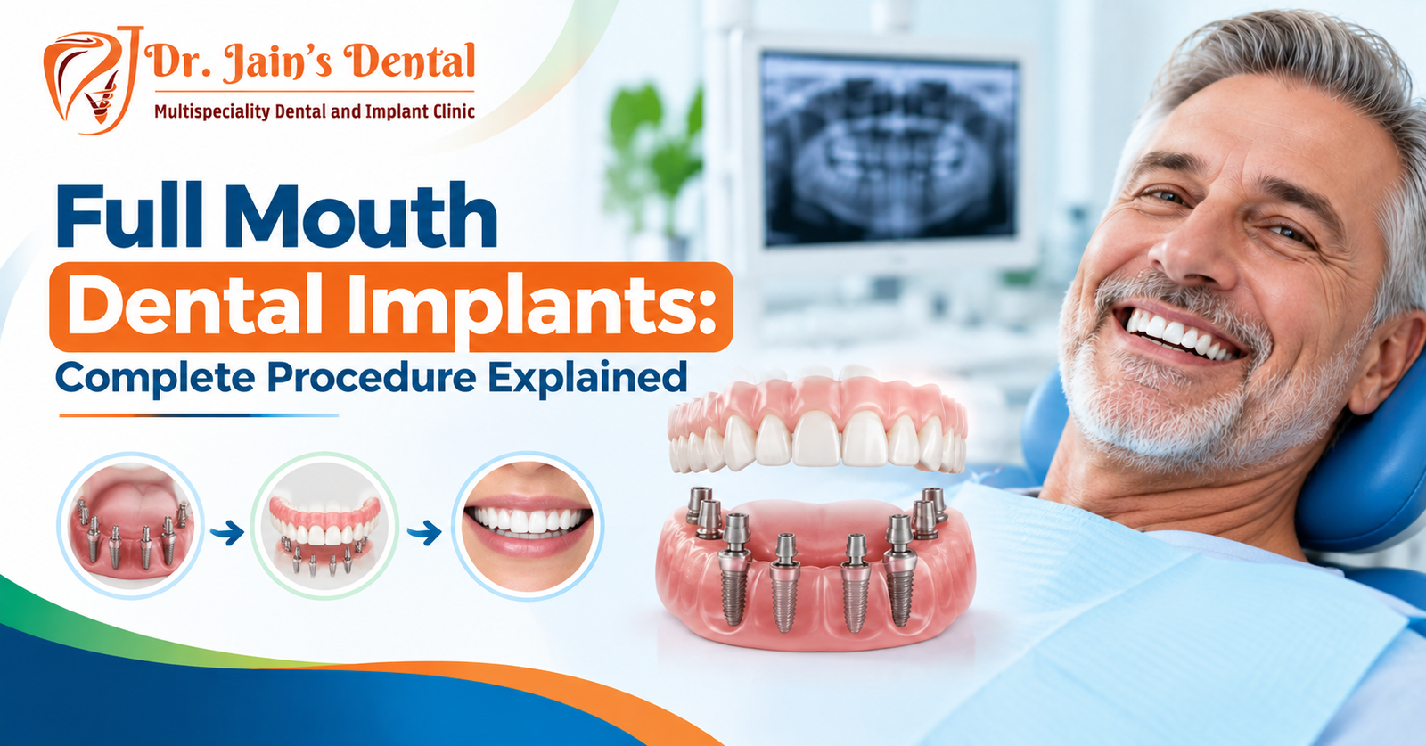Full Mouth Dental Implants: Complete Procedure Explained